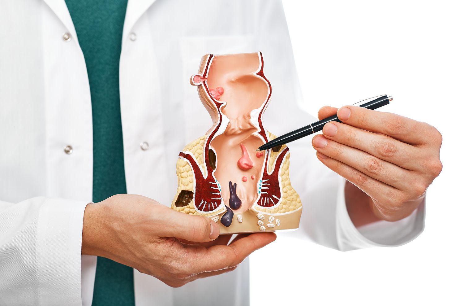 Basur (Hemoroid) Nedir? Belirtileri, Nedenleri ve Tedavi Seçenekleri